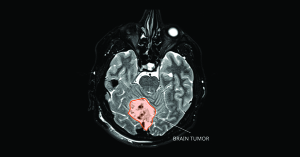 Medulloblastoma - National Cancer Institute